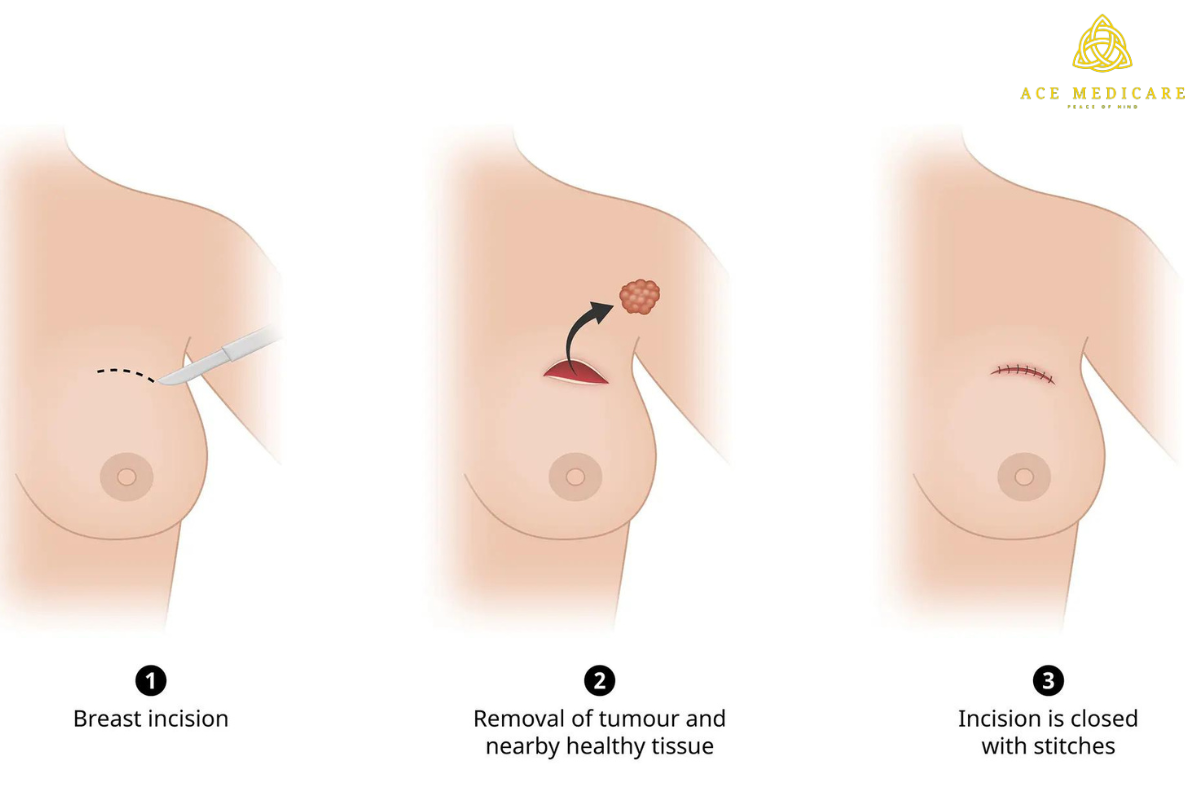 Understanding Breast Lumps: Causes, Symptoms, and Diagnosis